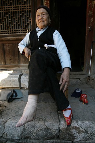 Chinese Deformed Feet