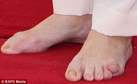Deformed Feet And Toes