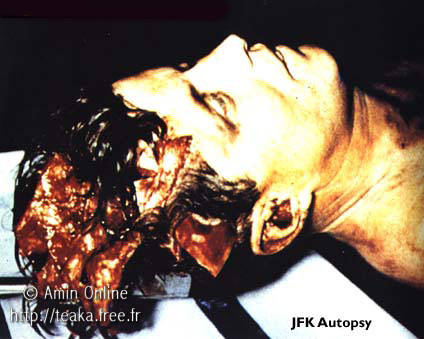Jfk Assassination Photos Head