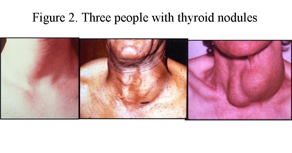 Multinodular Goiter On Thyroid