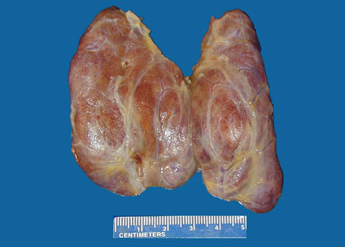 Multinodular Goiter On Thyroid