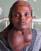 Picture Of Goiter Neck