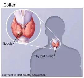 Thyroid Goiter Symptoms