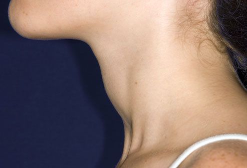 Thyroid Goiter Symptoms Treatment